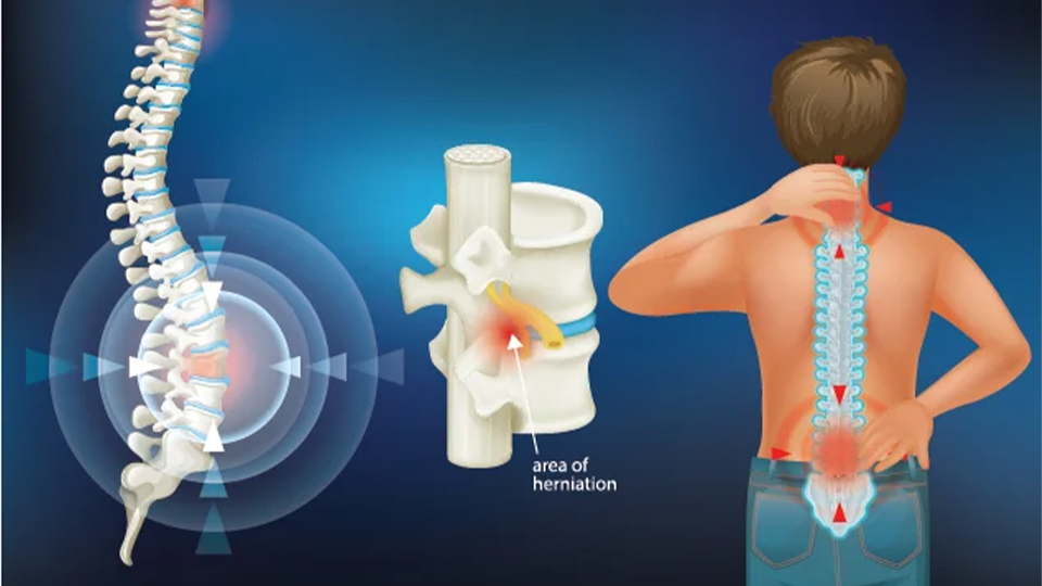 Spinal Cord Injury & Surgery